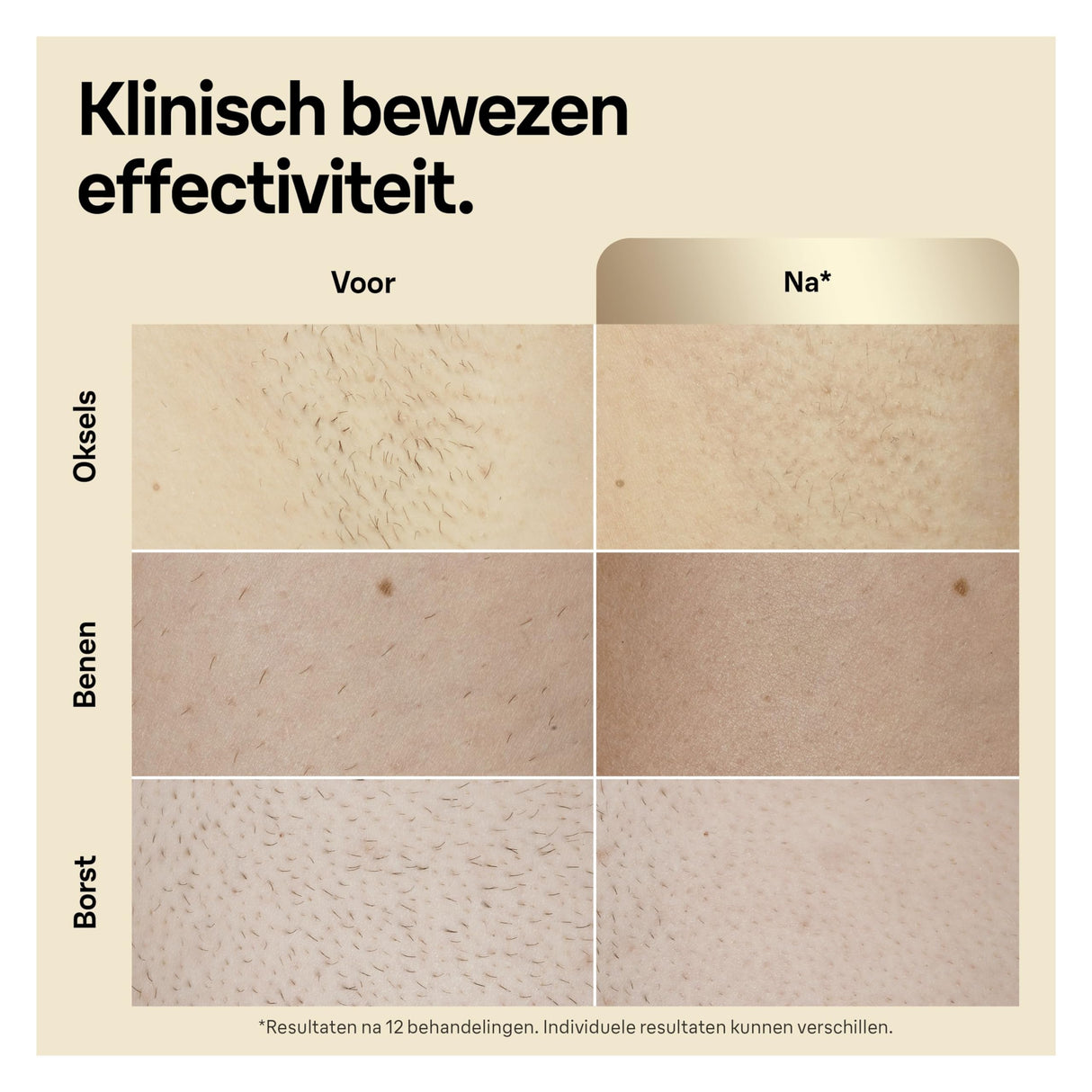 Braun IPL Silk-Expert Pro 5 PL5242 Depilación para el hogar, Blanco/Oro, Alternativa a la depilación láser, con caso, sistema de afeitado Venus, 3 cabezas, regalo para mujeres